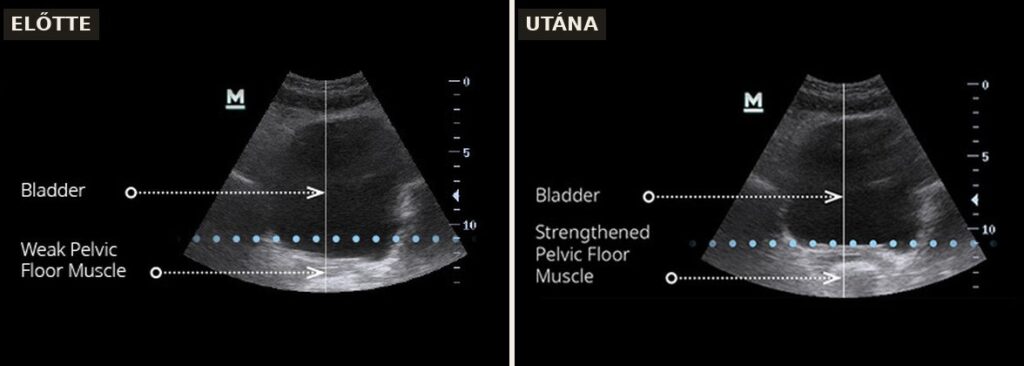 EMSELLA előtte-utána: medencefenék izomzat ultrahang felvételen (Forrás: BTL klinikai felvétel)