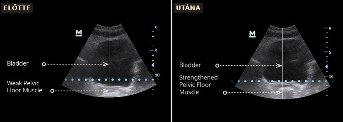 EMSELLA előtte-utána: medencefenék izomzat ultrahang felvételen (Forrás: BTL klinikai felvétel)