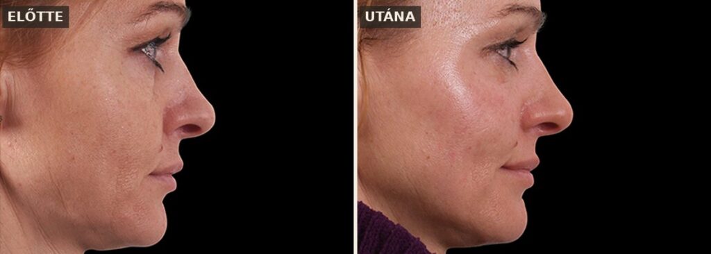 Exilis Ultra 360 előtte-utána: arc és nyak feszesítés (Forrás: BTL klinikai felvétel)