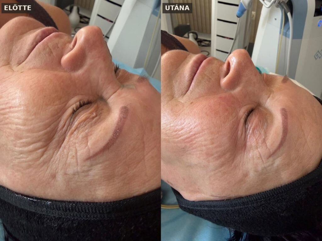 Felső arc és szem környéki ráncok – 3 Exilis Ultra 360 kezelés után, a Privée La Clinique saját páciense Miskolcon
