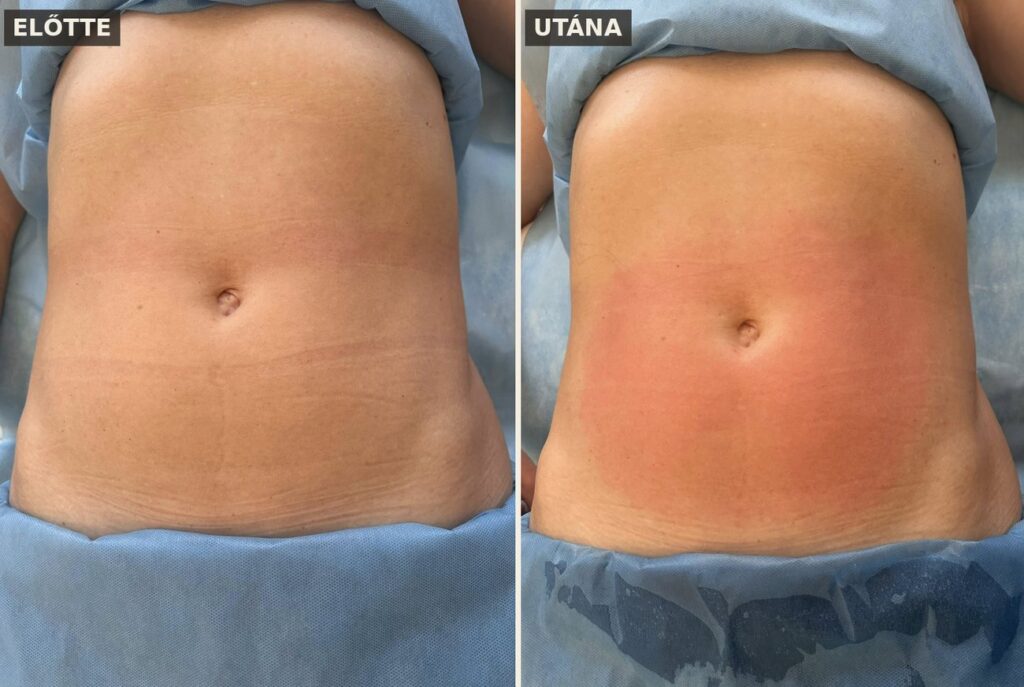 Has feszesítés előtte-utána egy Exilis Ultra 360 kezelés után – a Privée La Clinique saját páciense