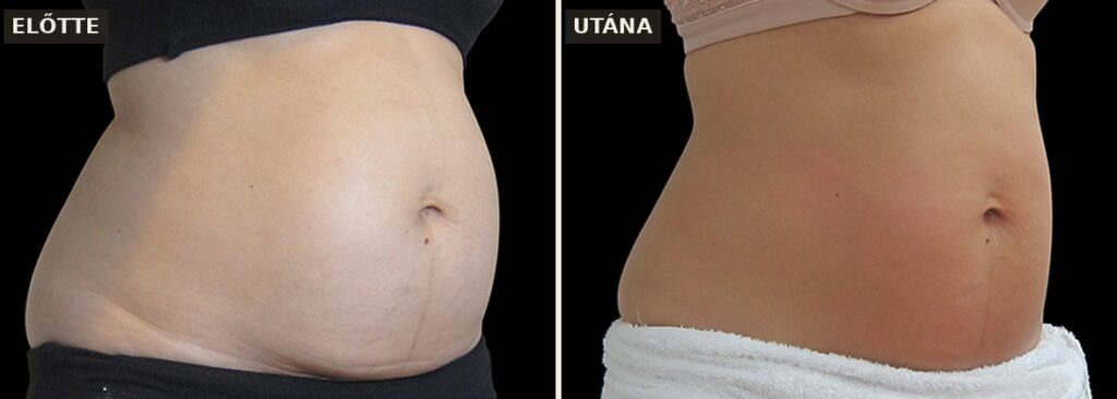 Exilis Ultra 360 előtte-utána: hasi zsírbontás és bőrfeszesítés (Forrás: BTL klinikai felvétel)