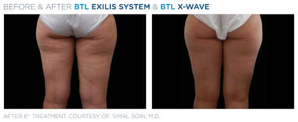 X-WAVE előtte-utána: comb cellulit kezelése (Forrás: BTL klinikai felvétel)