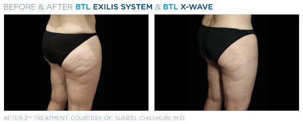 X-WAVE előtte-utána: comb és csípő cellulit oldalnézet (Forrás: BTL klinikai felvétel)