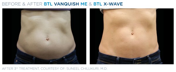 X-WAVE előtte-utána: has feszesítése (Forrás: BTL klinikai felvétel)